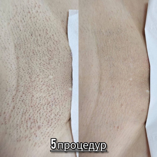 Забудьте о бритве: Как диодный лазер изменит вашу жизнь 